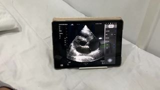 پروب اولتراسوند بی سیم دو سر برای قلب و POCUS
