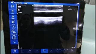 اسکنر اولتراسوند خطی بی سیم برای راهنمایی دقیق