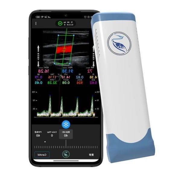 اسکنر اولتراسوند دستی بی سیم اکو کالر داپلر 100 فریم